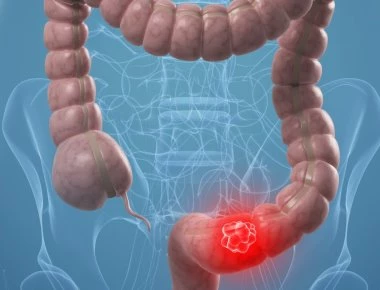 Καρκίνος εντέρου: Η «μαγική» διατροφή που μειώνει τον κίνδυνο θανάτου